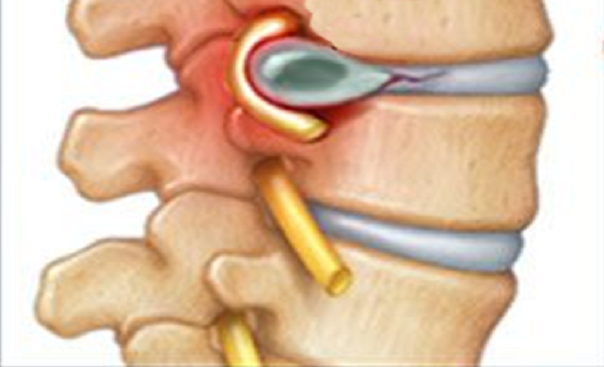 Spinal Cord Injuries